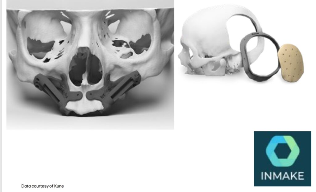 3D-gedruckte chirurgische Bohrschablonen