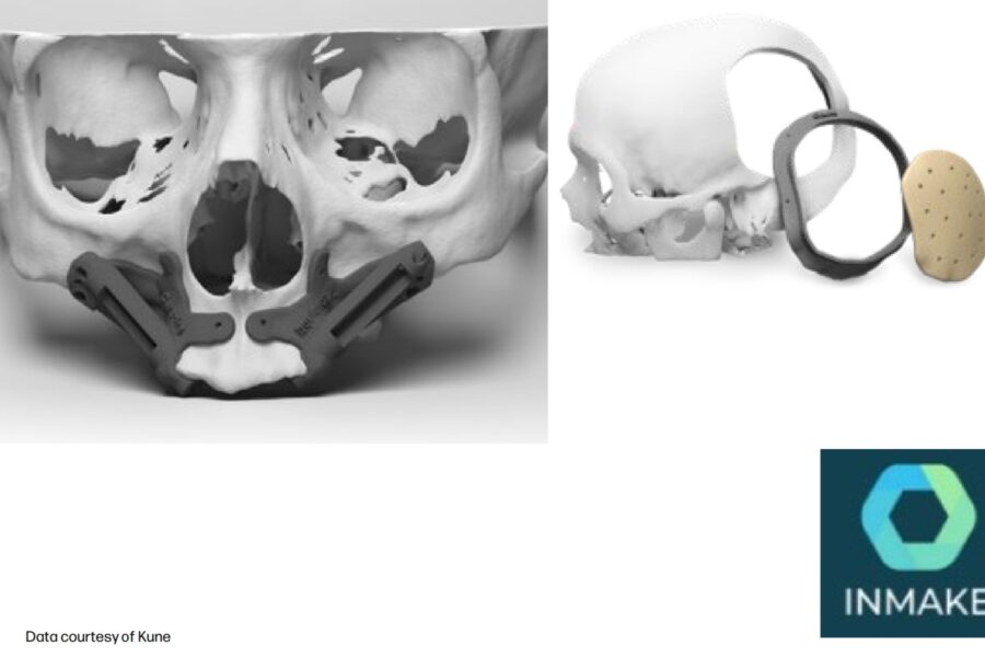 3D-gedruckte chirurgische Bohrschablonen